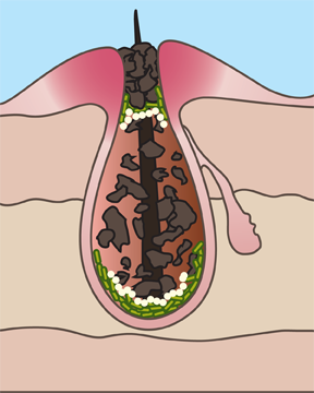 Acne begins in the cell